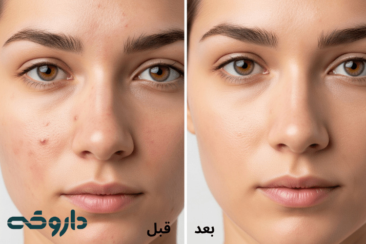 هیالورونیک اسید برای جوش