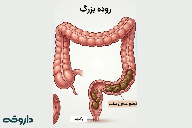 عوارض یبوست